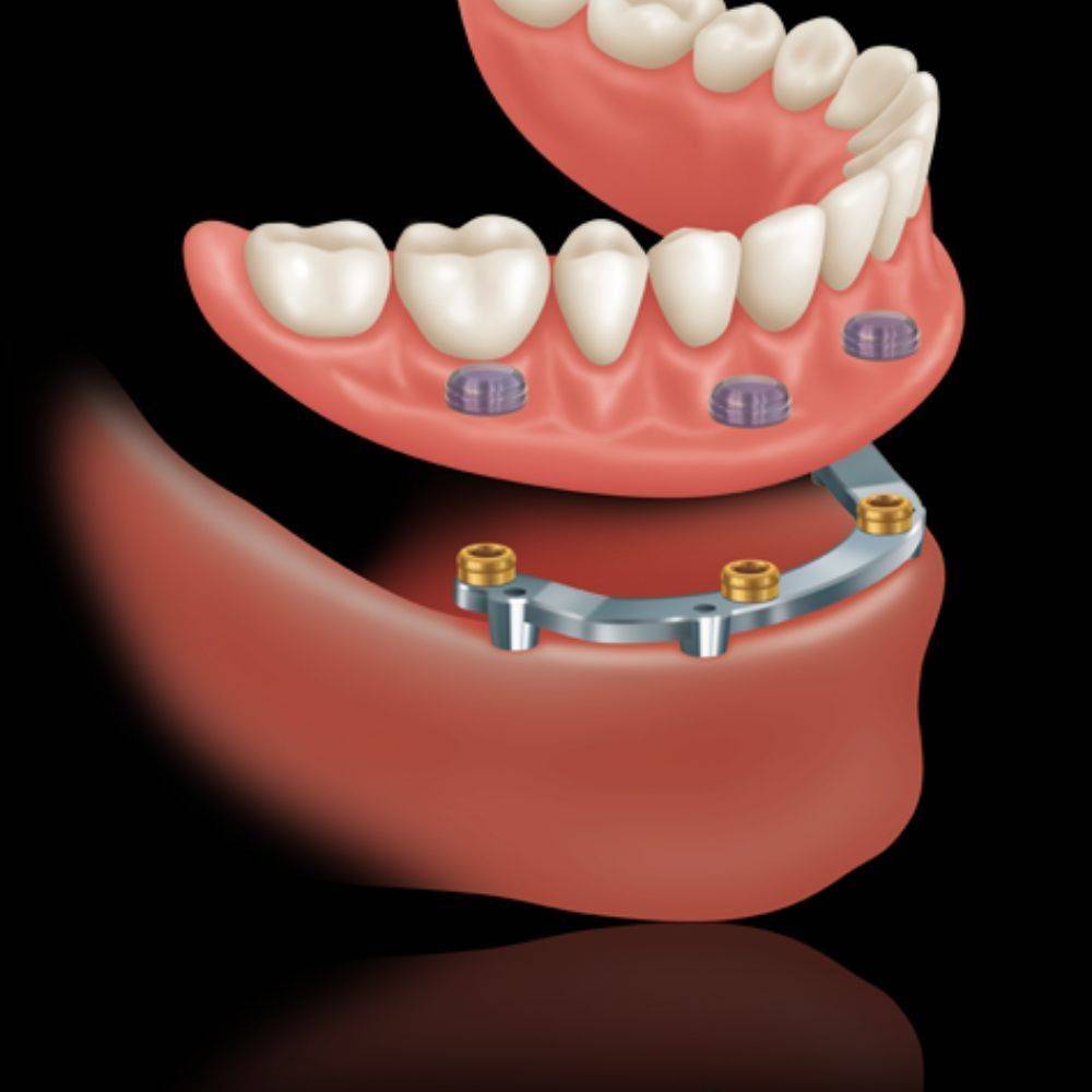 FOGBEÜLTETÉS TELJES FOGATLANSÁG ESETÉN