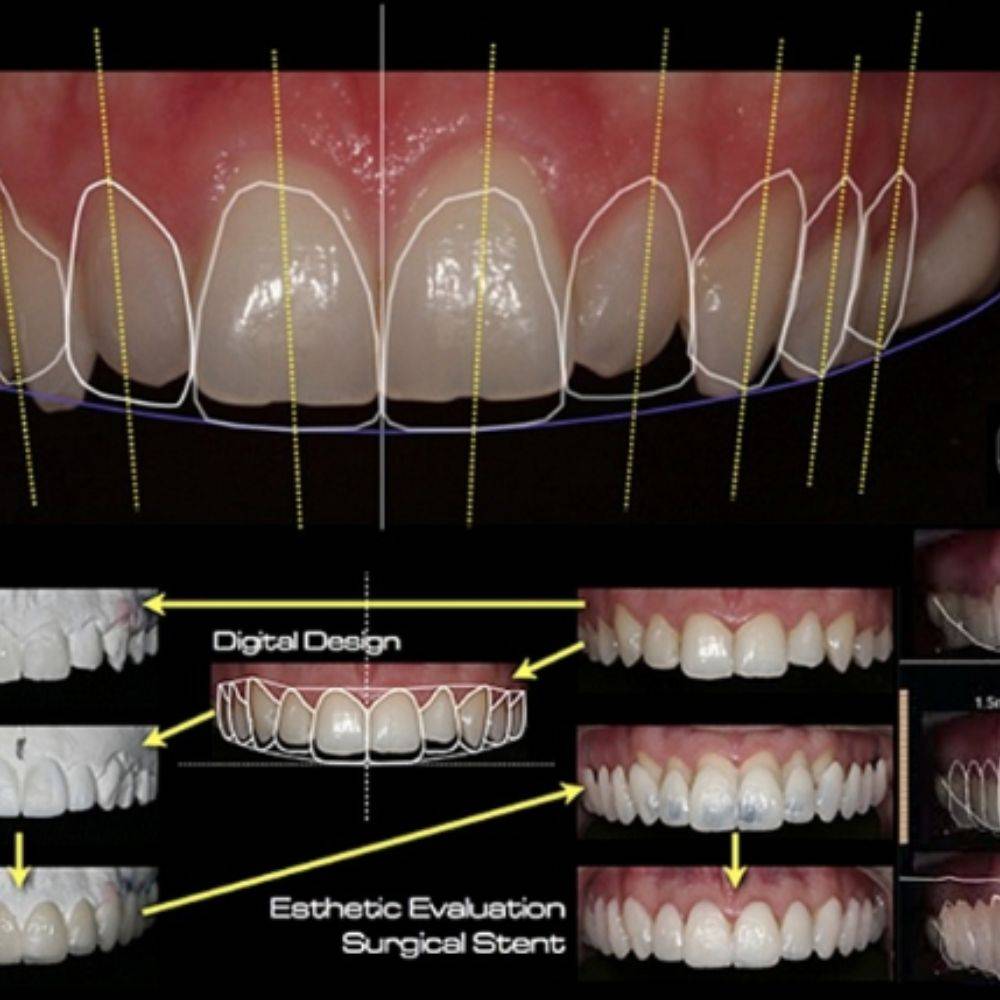 Fogak tervezése a smile design során